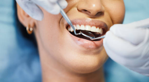 Best Emergency Tooth Extraction in Blossom, TX